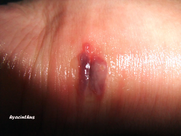 spider bite pictures blister. from the burst lister…